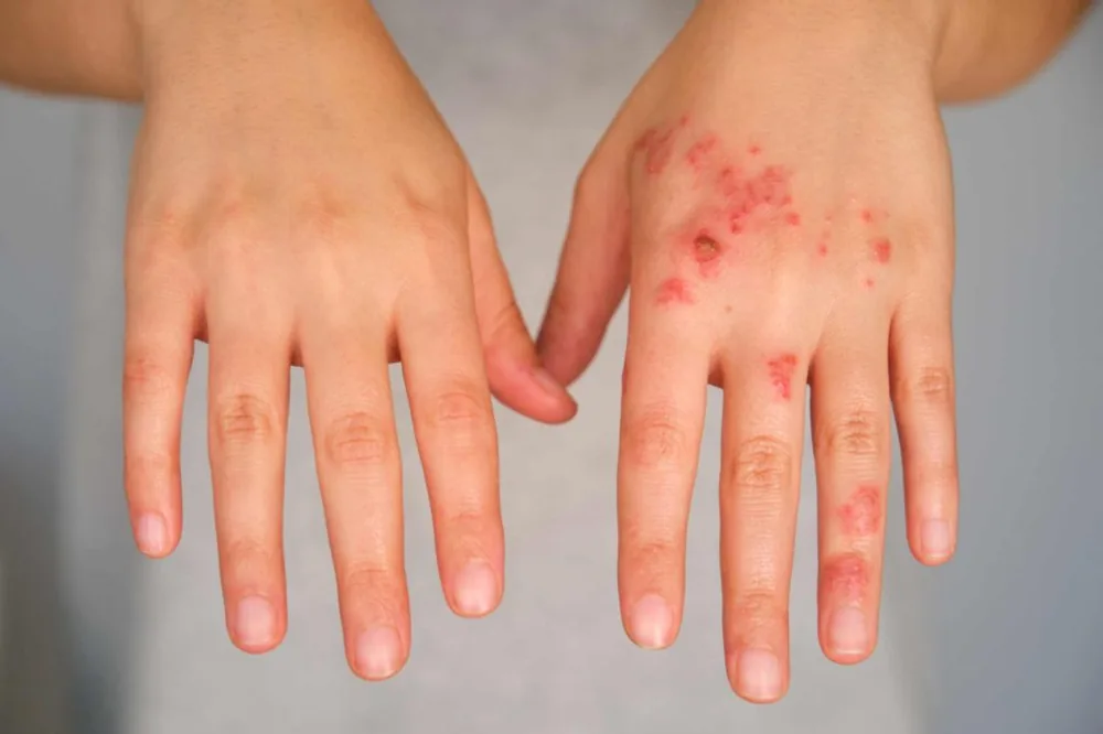 Hands showing red crusted impetigo sores on the skin
