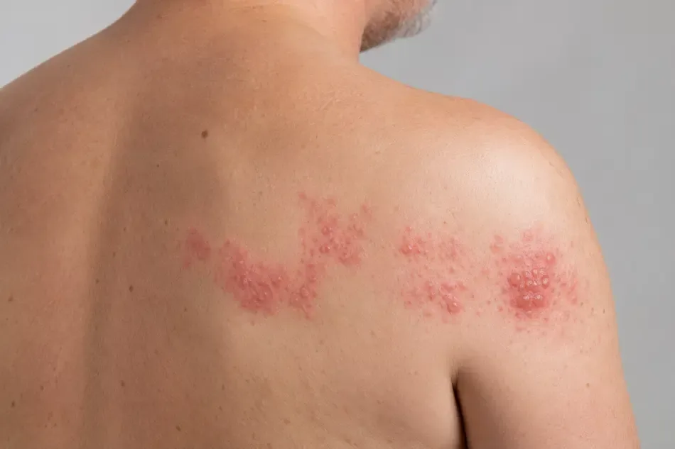 Shingles rash forming a band of blisters across a man’s shoulder and back