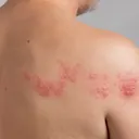 Shingles rash