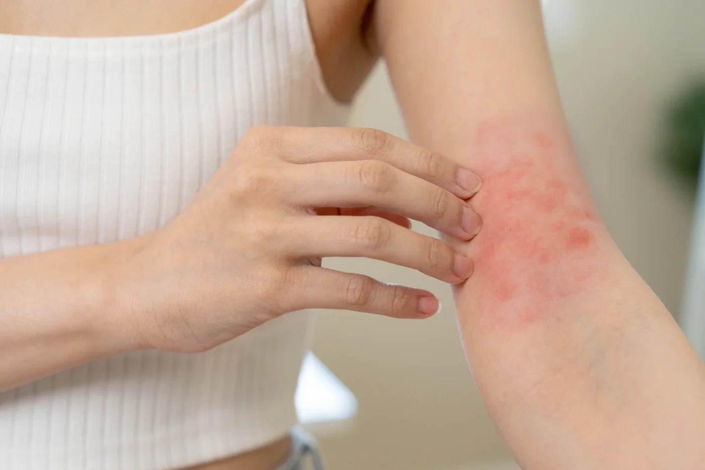 Cellulitis & infected skin